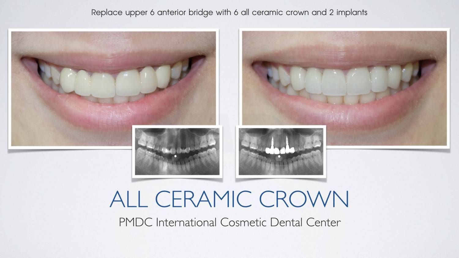 All Ceramic Crown PMDC Dental